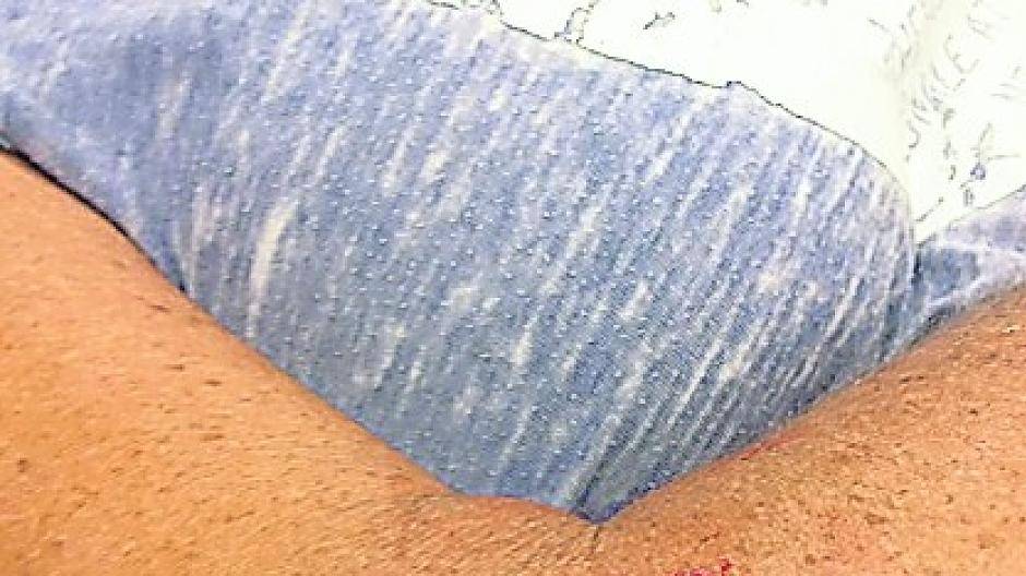  Deutlich Verletzungen an Arm und Hüfte waren die Folge. 
